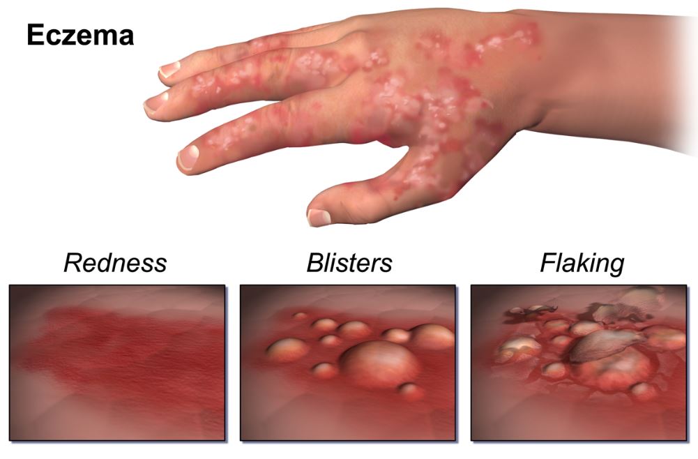 what eczema looks like